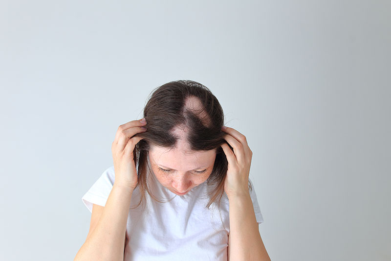 Hair Loss Solutions in Kensal Rise | Speak Volumes gallery image 12