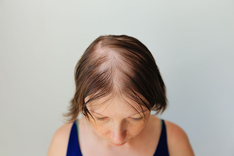 Hair Loss Solutions in Kensal Rise | Speak Volumes gallery image 13